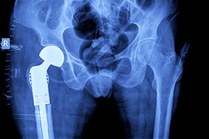 hip-implant-replacement